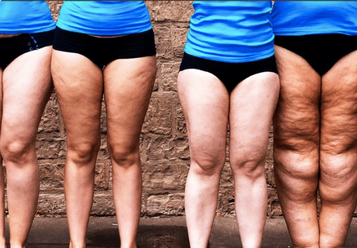 Lipedema: doença ainda pouco conhecida afeta milhões de brasileiras